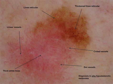 Melanoma Skin Cancer Amelanotic Melanoma Overview
