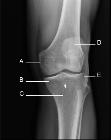 Diagram Oblique Knee X Ray With Lateralexternal Rot Lab Review