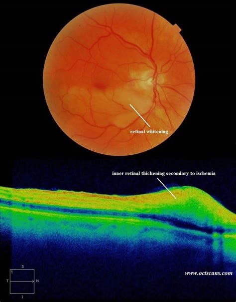 Retinal Artery Occlusion Optical Coherence Tomography Scans