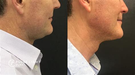 Coolsculpting Fat Freezing Double Chin Pulse Light Clinic London