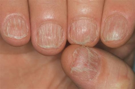 Elimina El Hongo De Las Uñas Para Siempre Con Este Remedio Natural