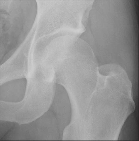 Pistol Grip Deformity Of The Femoral Head With Mild Posterior And