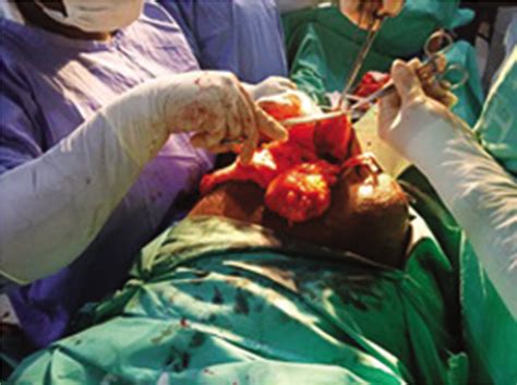 Giant Epigastric Hernia Induced By The Second Stage Of Labor In An