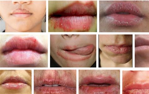 Eczema On Lips Causes Symptoms Treatment And Home Remedies