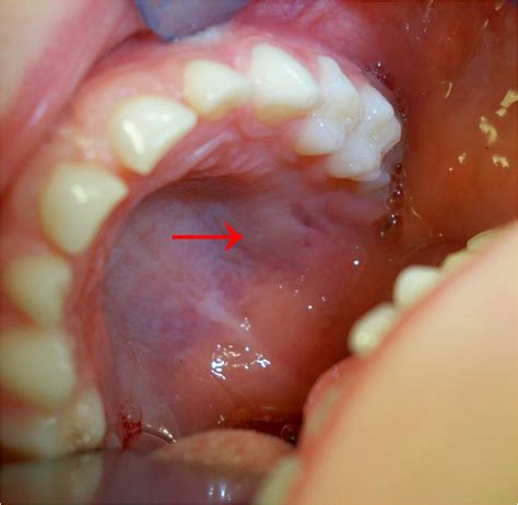 Mucoepidermoid Carcinoma Of The Left Posterior Hard Palate Appearing As