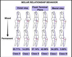 Step 2 preoperative planning for the best outcome. Factors influencing molar relationship behavior in the ...