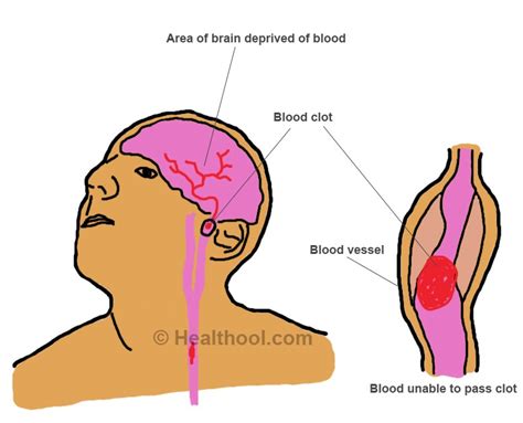 Blood Clots In The Brain Symptoms Causes Treatment