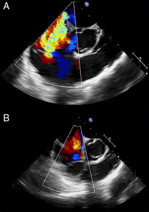 Mid Esophageal Right Ventricular Inflow Outflow View Before A With