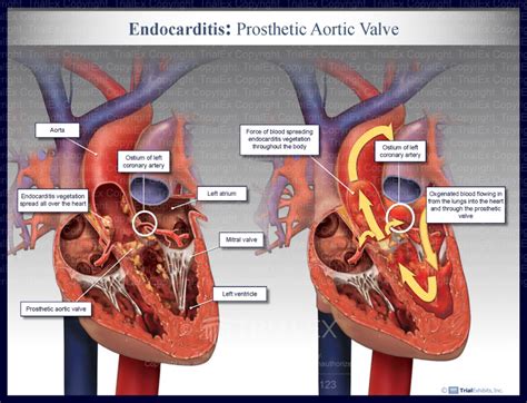 Endocarditis Prosthetic Aortic Valve Trial Exhibits Inc