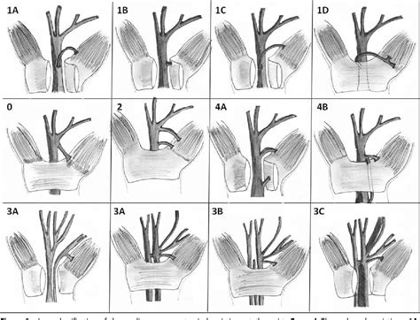 Figure 3 From Anatomic Variations Of The Median Nerve In The Carpal
