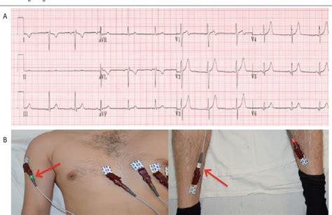 Figure 6 From Common Ecg Lead Placement Errors Part I