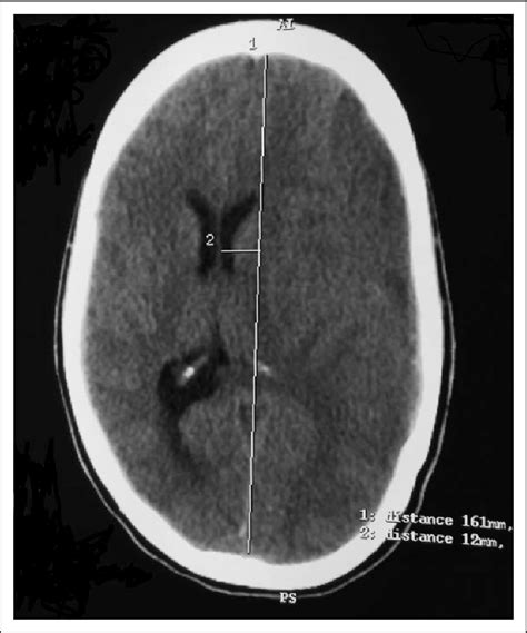 Plain Computed Tomography Scan Of Brain Chronic Subdural Hematoma In