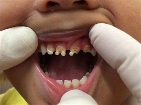 5 歲男孩乳牙全毀，可能造成永久缺牙，凶手竟然是全球大受歡迎的 這個