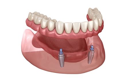 Seven Benefits Of Mini Dental Implants