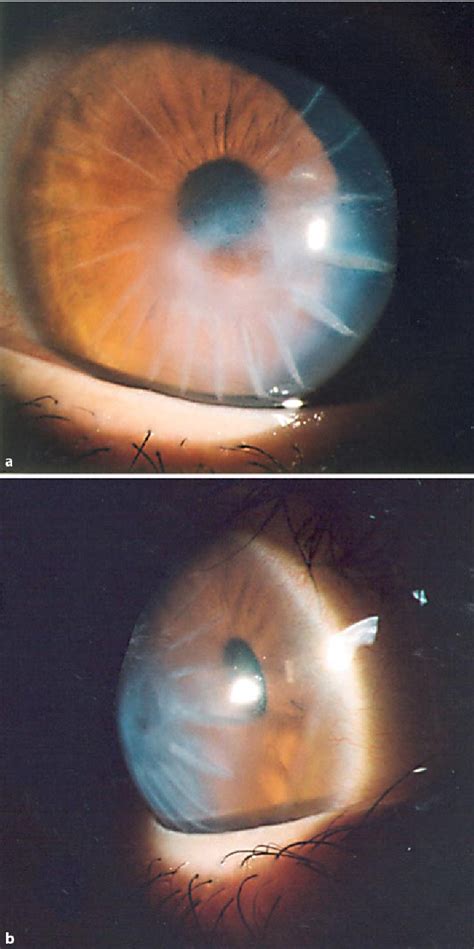 Figure 1 From Penetrating Keratoplasty After Radial Keratotomy And Recurrent Immune Overreaction