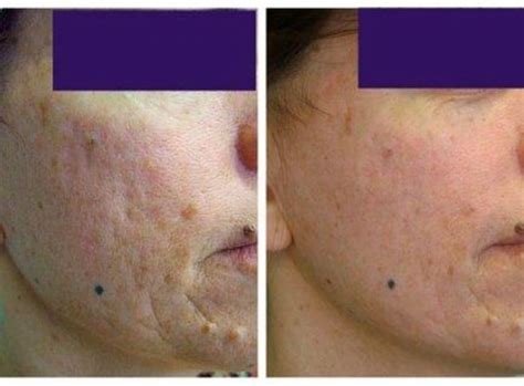 Dull Skin Meaning Causes And Treatment Auckland Nz Palm Clinic