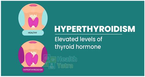 Affordable Medical Care For Hyperthyroidism Or Overactive Thyroid