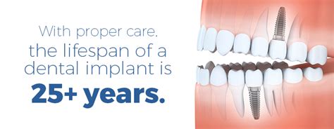 How Long Do Teeth Implants Last Dental News Network