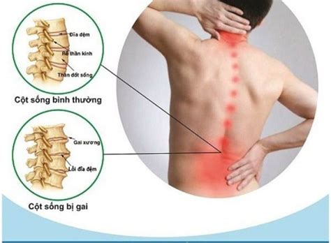 Bệnh Gai Cột Sống L4 L5 Là Gì Triệu Chứng Cách Điều Trị