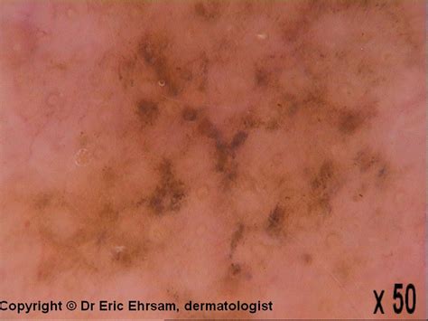 Dermoscopy Recurrent Lentigo Maligna Melanoma