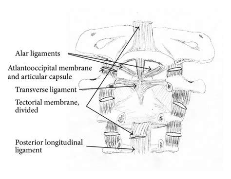 Ap A And Lateral B X Rays Depicting A C1 2 Fusion Using C1 Lateral