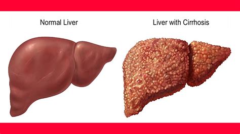 What Is The Life Expectancy Of Liver Cirrhosis Md