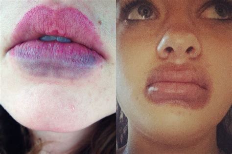 El Reto Para Obtener Labios Como Kylie Jenner Es El Nuevo Furor En Las Redes Sociales