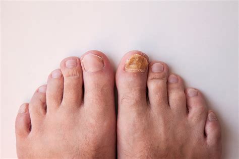 What Causes Toenail Fungus How Can It Be Treated Arizona Foot Doctors