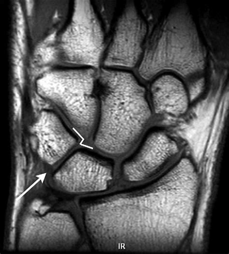 Ulnar Sided Wrist Pain In The Athlete Orthopedic Clinics