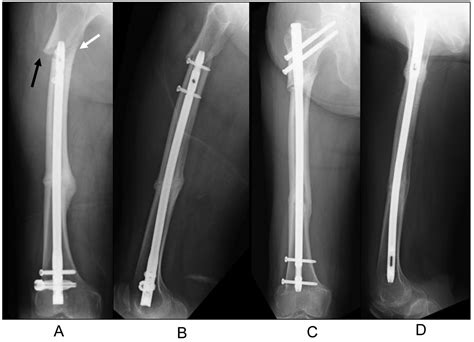 Periprosthetic Fracture Resembling Atypical Femoral Fracture After