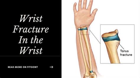 Fitoont2 — Buckle Fracture Wrist Symptoms And Healing Time