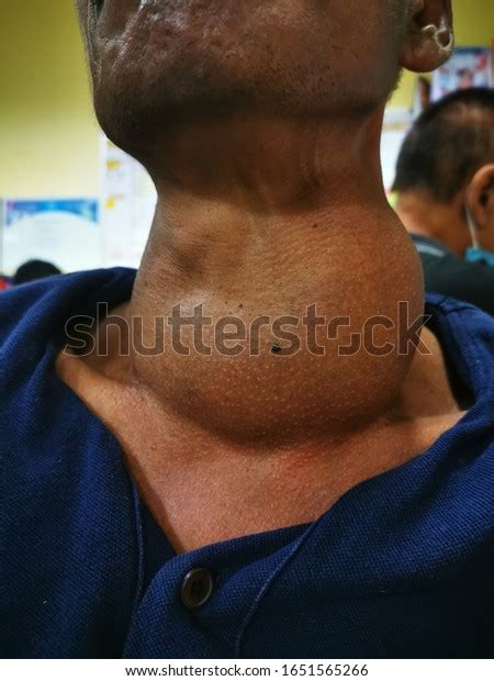 Huge Giant Multinodular Goitre Swelling Derived Stock Photo 1651565266