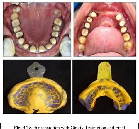 Figure 3 From Rehabilitation Of Severely Worn Dentition Using Full