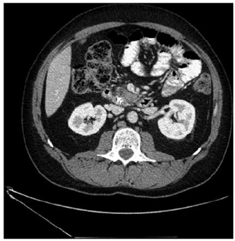 Contrast‐enhanced Computed Tomography Scan Performed Prior To