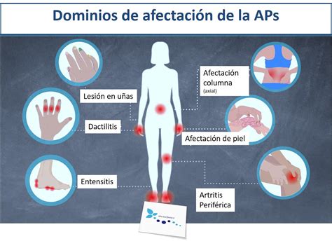 Recomendaciones En El Manejo De La Artritis Psoriasica Cl Nica