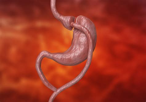 One Anastomosis Gastric Bypass In Patients With Gerd Hiatal Hernia Gastroenterology Advisor