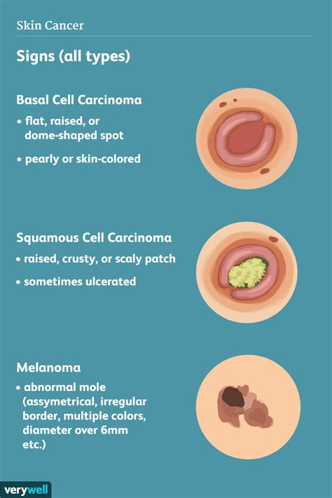 Symptoms Of Skin Cancer