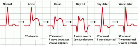 Detail Contoh Gambar Ekg Stemi Koleksi Nomer 6