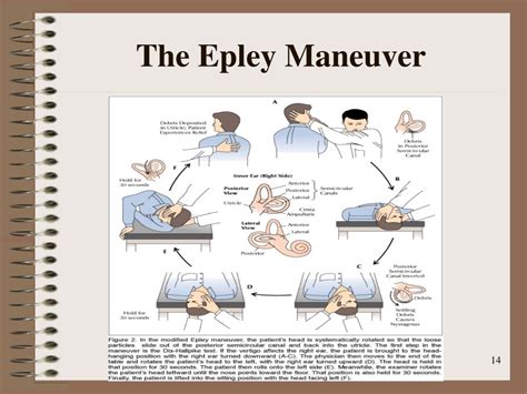 Printable Epley Maneuver Patient Handout