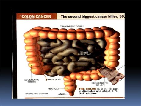 Colonrectal Cancer Flashcards Quizlet