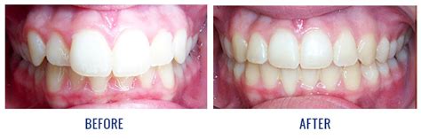 How to fix an overbite? Smile Gallery - Before and After Patient Photos | Dingus ...