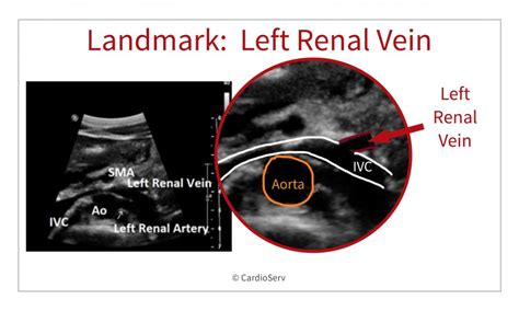 Aorta And Renal Artery