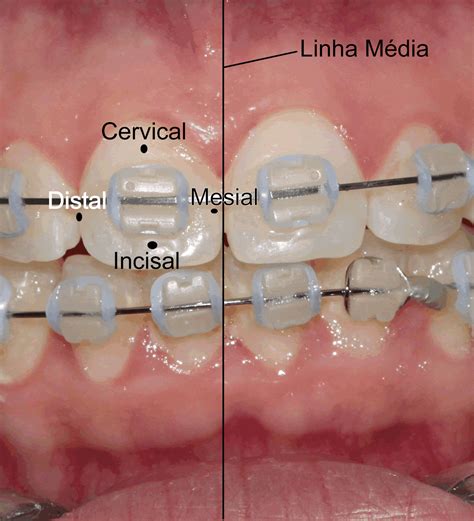 Face Mesial E Distal