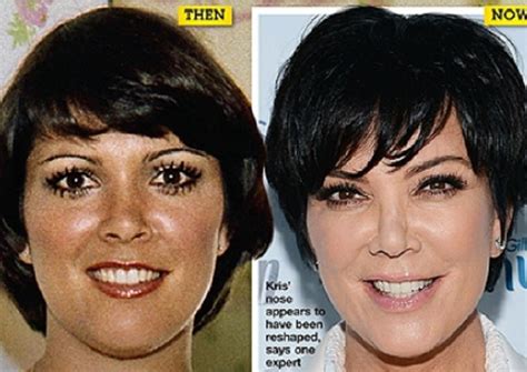 Kris Jenner Then And Now After Plastic Surgery Celebrity Plastic Surgery Online
