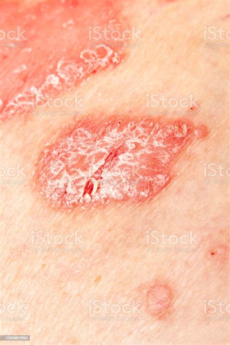 Detail Of Psoriatic Skin Disease Psoriasis Vulgaris With Narrow Focus