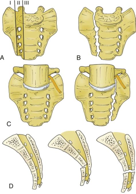 The Denis Classification Of Sacral Fractures A The 3 Zones Zone I