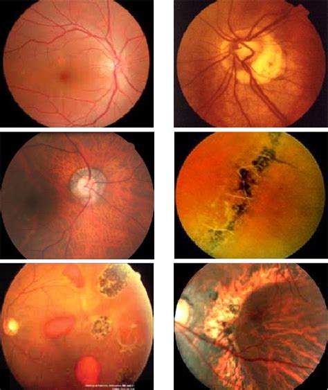 Figure 1 From Learn To Recognize Pathological Myopia In Fundus Images
