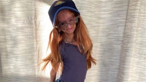 Morta Adalia Rose La Youtuber 15enne Che Raccontava La Sua Vita Con La Sindrome Della Progeria
