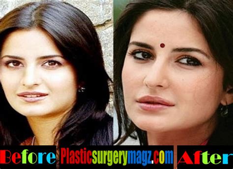 katrina kaif plastic surgery before and after pictures plastic surgery magazine