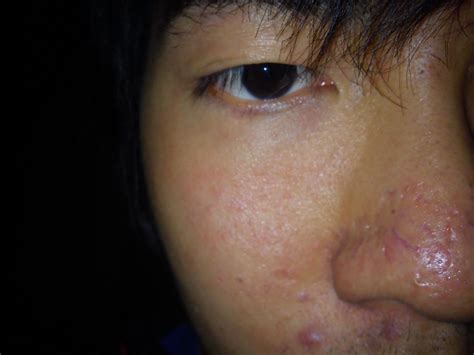 Ice Pick Scars On Nose With Pictures Scar Treatments Community